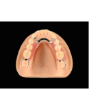 METAL PARTIAL DENTURES