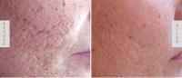 The New Standard: Benefits of Fractional CO2 Laser Skin Resurfacing