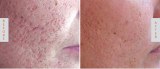 The New Standard: Benefits of Fractional CO2 Laser Skin Resurfacing