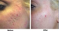 Fractional CO2 laser: A guide to skin resurfacing and renewal