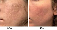 Fractional CO2 Laser Resurfacing Restores Your Skin