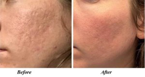 Fractional CO2 Laser Resurfacing Restores Your Skin