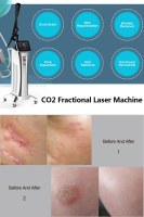 The Gold Standard for skin resurfacing – CO2 laser resurfacing!