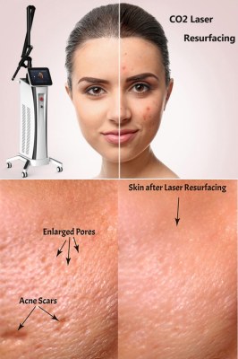 Acne scar treatment: CO2 laser skin resurfacing