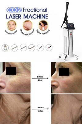 The Most Advanced In Skin Resurfacing of CO2 Laser