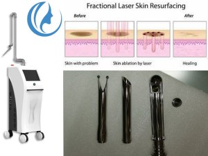 Tratamiento laser co2 para cicatrices de acne
