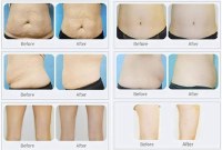 What problems does Cryolipolysis solve?