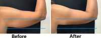 Cryolipolysis Fat Freezing: Non Surgical Fat Reduction, Body Contouring