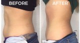 What happens after Cryolipolysis?