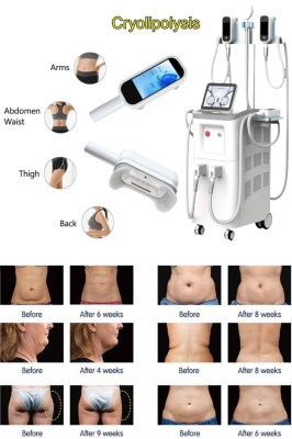 Cryolipolysis – The Nonsurgical Fat Reduction Procedure