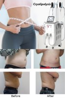 Everything you need to know about cryolipolysis treatment of fat