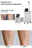 Diode Laser Hair Removal – Mechanism, Benefits and Queries!