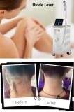 Diode laser: full understanding about permanent laser hair removal treatment