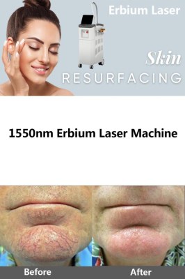 What skin concerns can an Erbium laser treat?