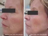 Why Erbium Laser Resurfacing Improves Skin Confidence