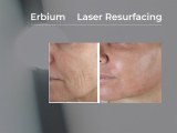 Erbium Laser Resurfacing: Addressing Common Questions