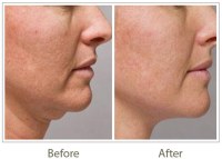 HIFU Skin Tightening: Firm Skin Without Surgery