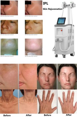 What skin conditions does IPL treatment?