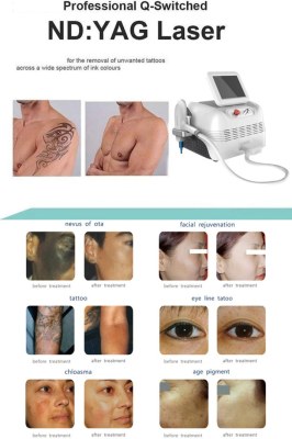 ND YAG Laser for Skin Treatment - Spots Removal