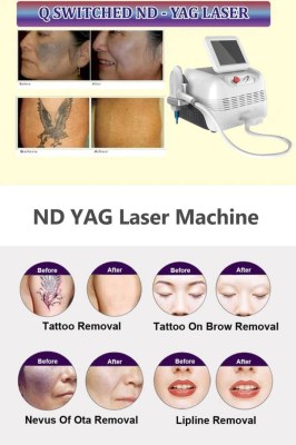 What does the ND YAG laser skin treatment involve?