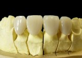 Selling Dental PFM-Porcelain fused to Colbat-Chrome alloy crown