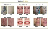 Picosecond Laser Facial Revitalization: Improving Sun-Damaged, Aged or Scarred Skin