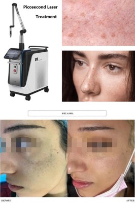 How Long To See Results From Picosecond Laser Treatments (Timeline)