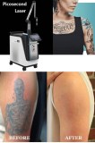 Picosecond Laser technology helps treat tattoos freckles and wrinkles