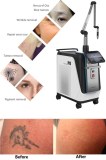 Picosecond laser tattoo removal: your comprehensive guide