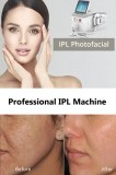 What to know about intense pulsed light IPL treatment