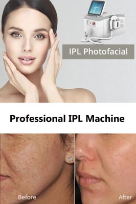 What to know about intense pulsed light IPL treatment