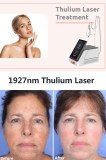 What does Thulium Laser do?