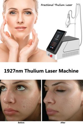 Good candidate for fractional thulium laser treatment