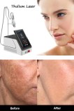 Thulium Laser Spot Treatment