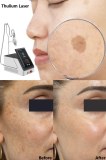 Thulium Laser in the Treatment of Pigmentation: An Innovative Approach in Dermatology